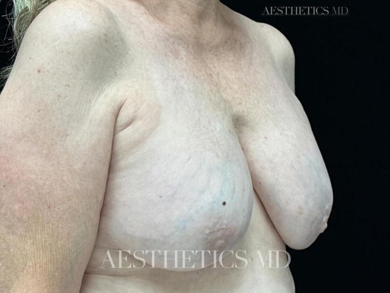 Breast implant removal Newport Beach | Before & After Photo