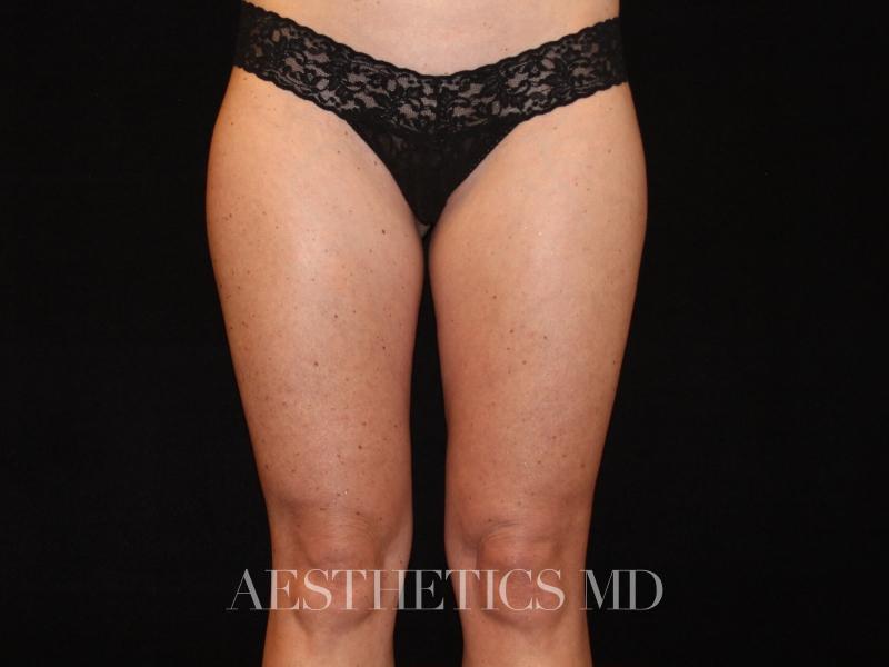 Liposuction Newport Beach | Before & After Photo