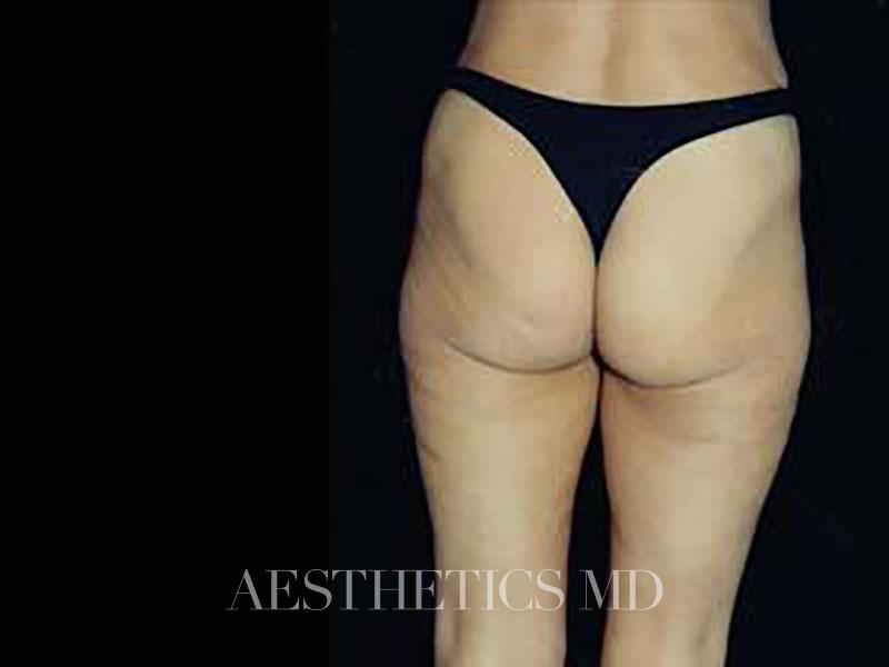 Lower body lift Newport Beach | Before & After Photo