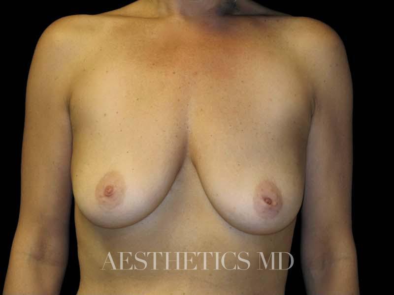 Breast augmentation with lift Newport Beach | Before & After Photo