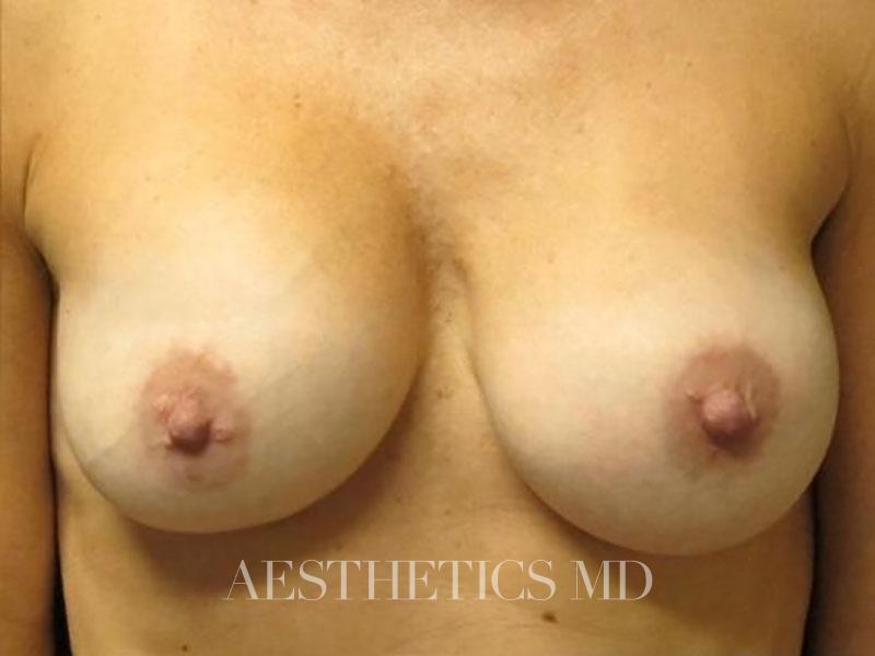 Nipple revision Newport Beach | Before & After Photo