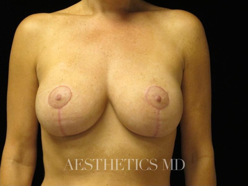 Nipple revision Newport Beach | Before & After Photo