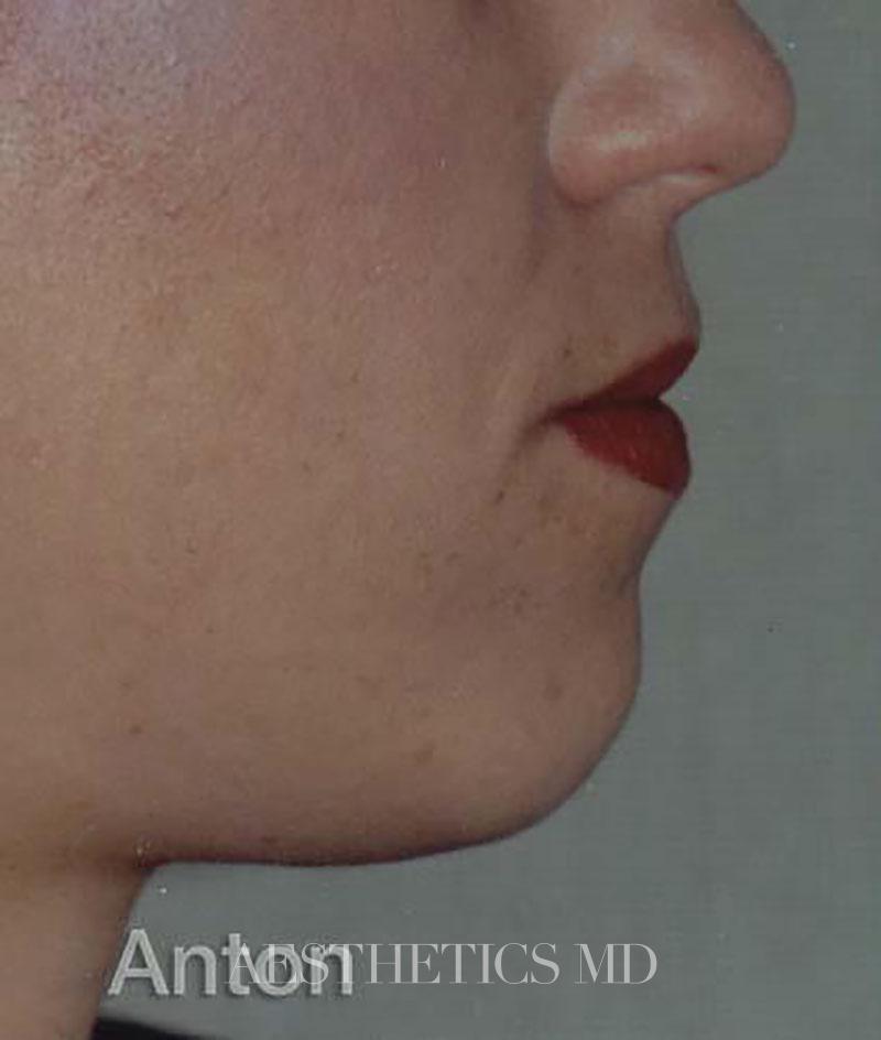 Chin and cheeks Newport Beach | Before & After Photo