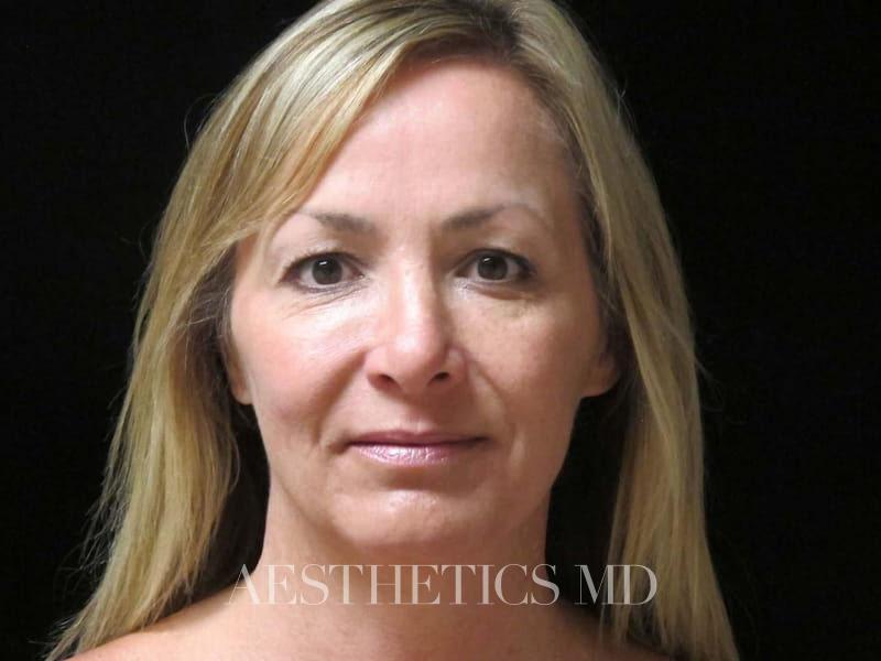 Facelift Newport Beach | Before & After Photo